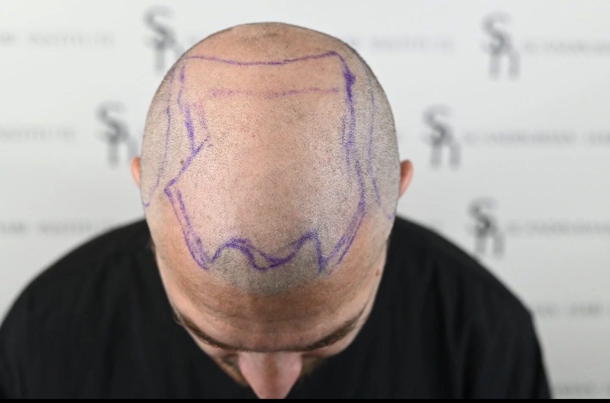 Planning hair line