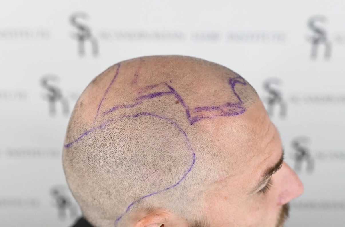 Plan for hair transplant