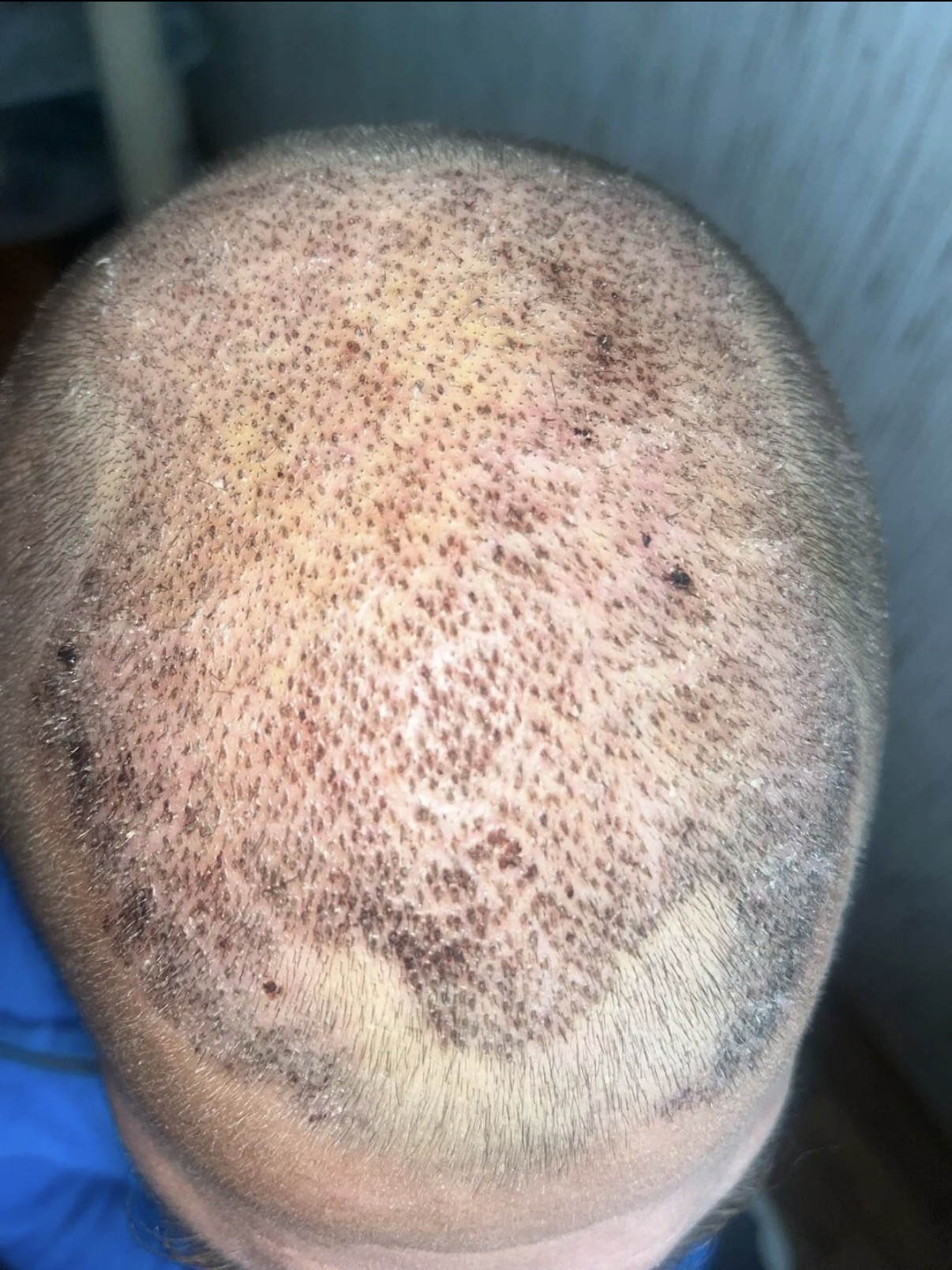post op after hair transplant