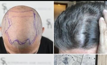 My detailed journey, Danish patient, dr Emil George, 3300 grafts - surgery done in end of august 2025 12 Month Results