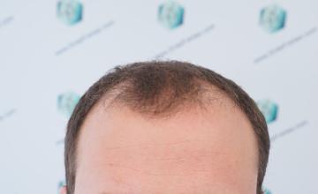 Dr. Rafael de Freitas - 4.818 Grafts - 6.291 Hairs - FUE + DHI