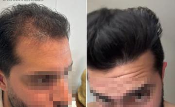 Before and After