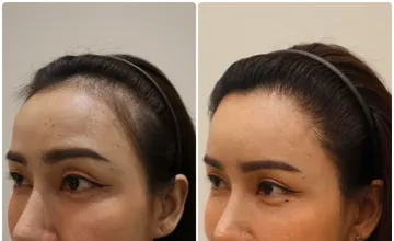 Before and After